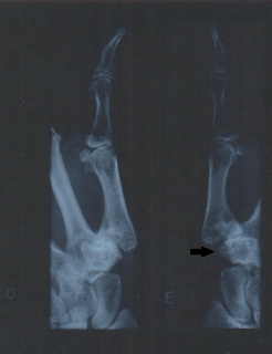 Radiografia pré-operatória. Seta a indicar a articulação da base do polegar esquerdo. Clique para ampliar.
